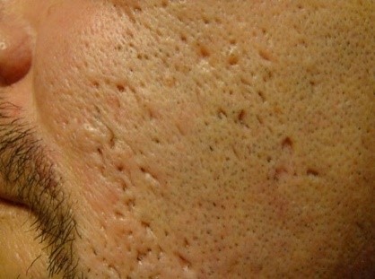 how to get rid of acne scars
