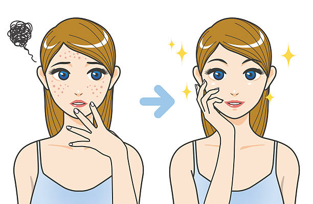 How to get rid of Pimples and Acne Scars?