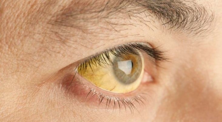 Jaundice: Symptoms, Causes, Risk Factors, and Treatment in Nepal