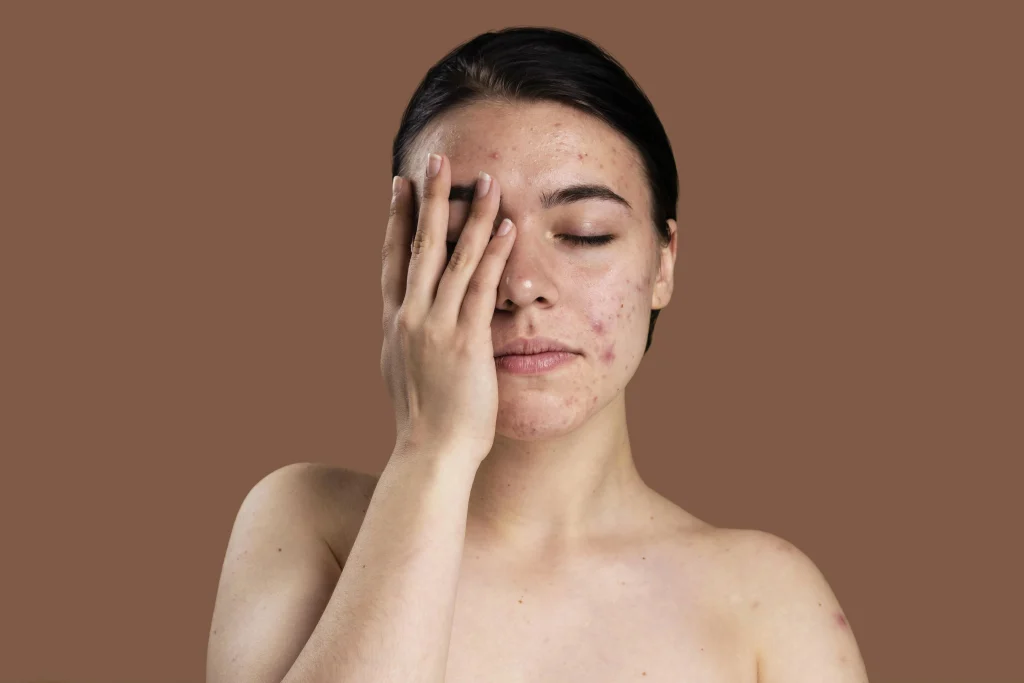 Skin Problems in Summer | How To Prevent Them?