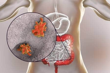 Dysentery: Causes Symptoms and Treatment in Nepal
