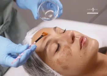 Chemical Peel Treatment