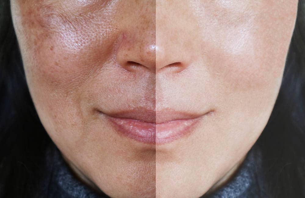 (पोतो /कालो दाग ) Melasma Treatment in Kathmandu, Nepal at Clinic One?