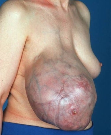 Phyllodes Tumor