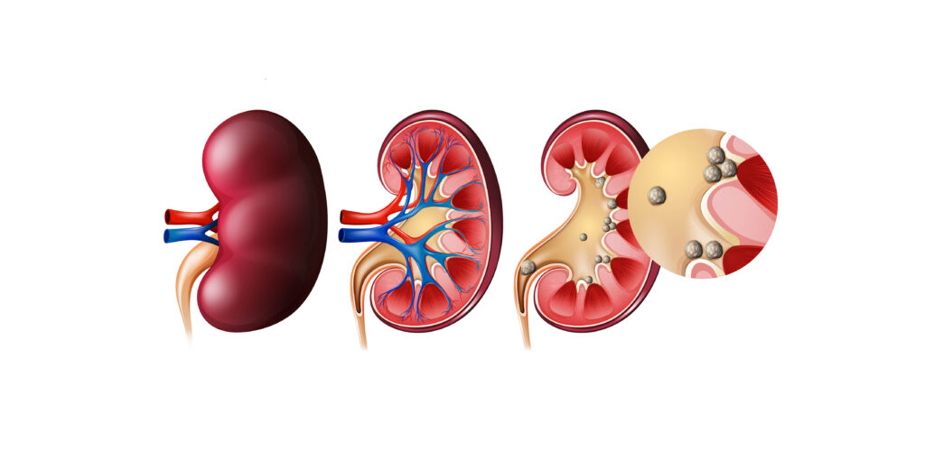 यसकारण देखिन्छ मिर्गाैला पत्थरी (Kidney Stone), के हो उपचार ?
