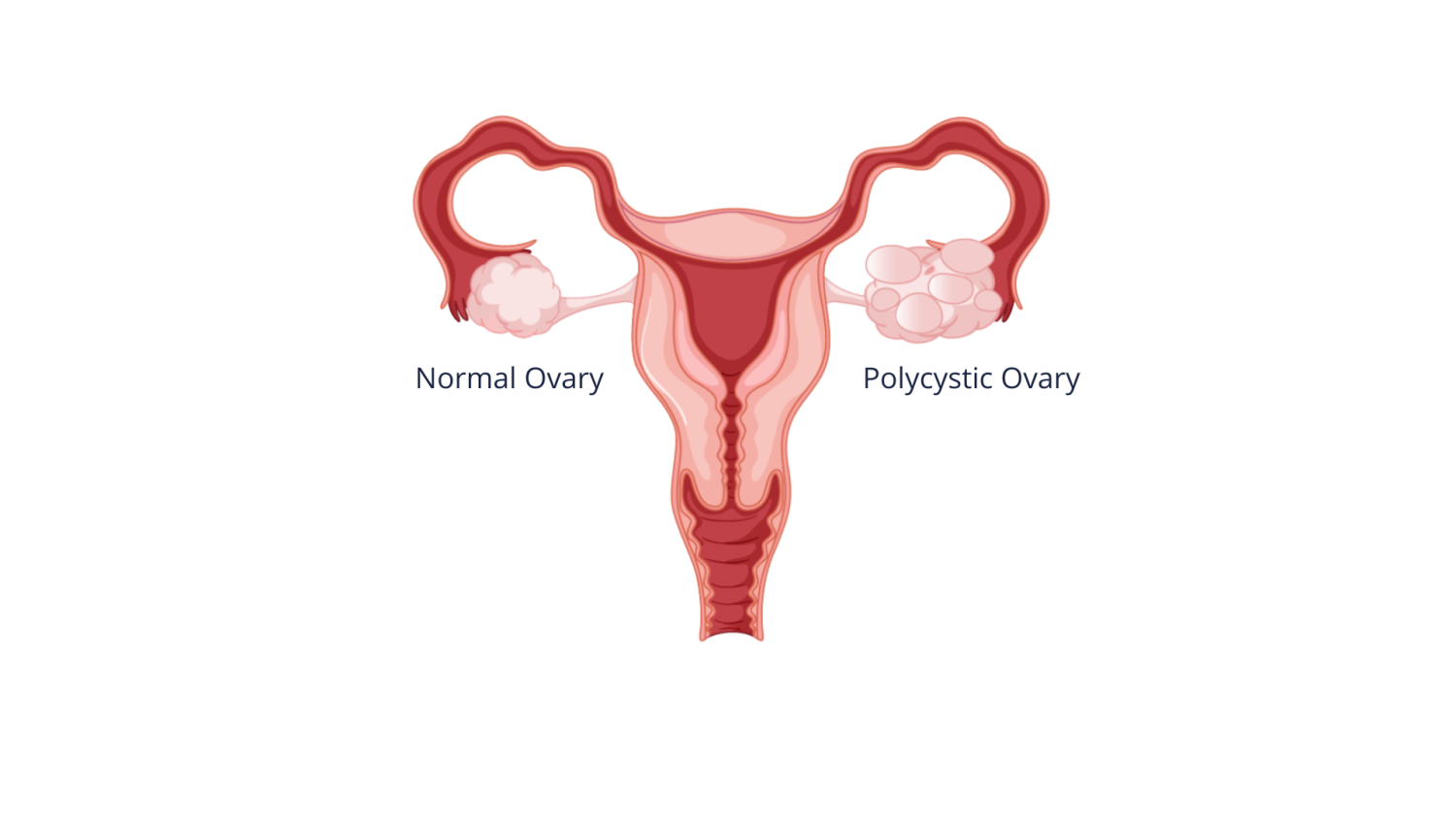 PCOS – Polycystic Ovarian Syndrome