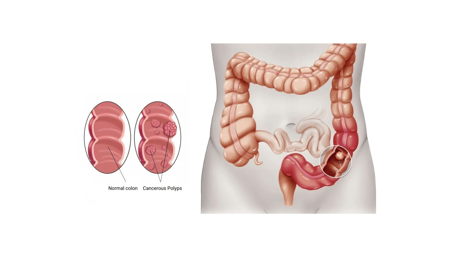 Colorectal Cancer
