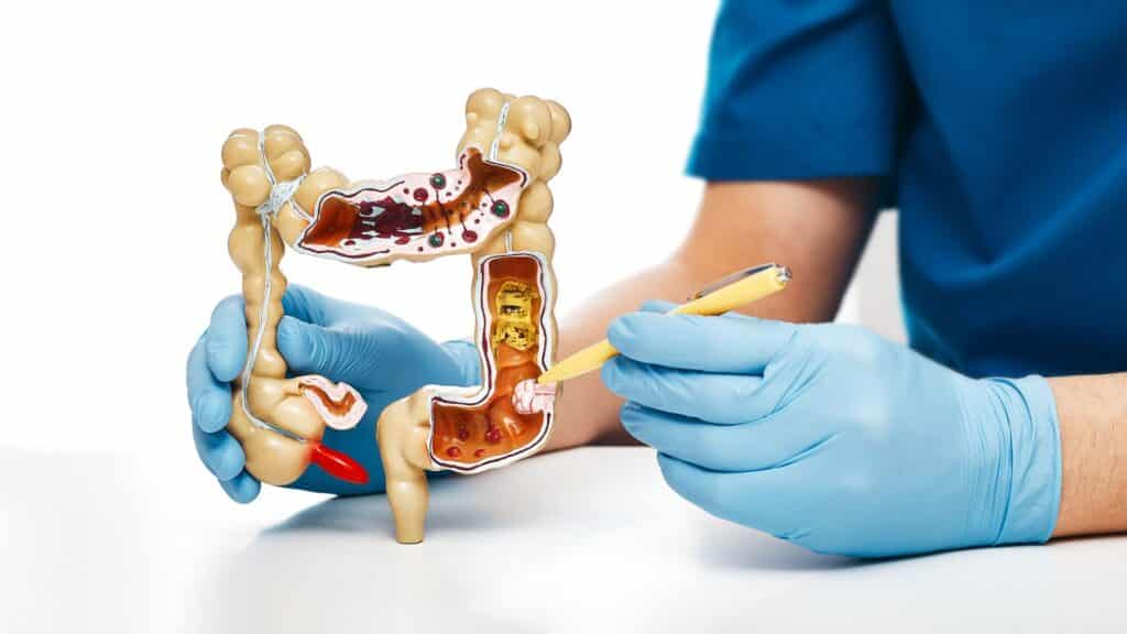 Polypectomy in Kathmandu
