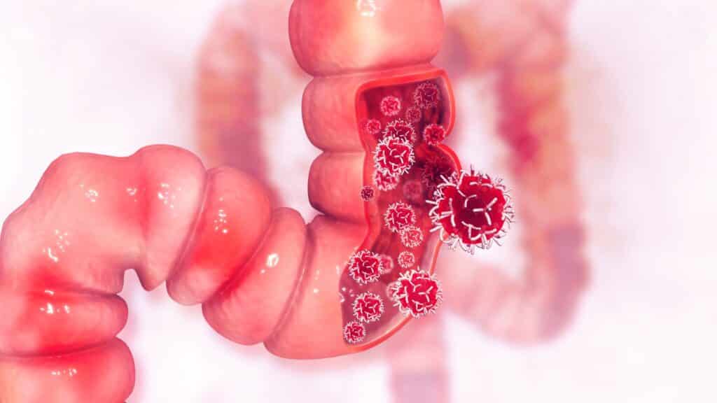 Polypectomy for colon polyps