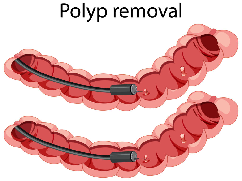 Polypectomy