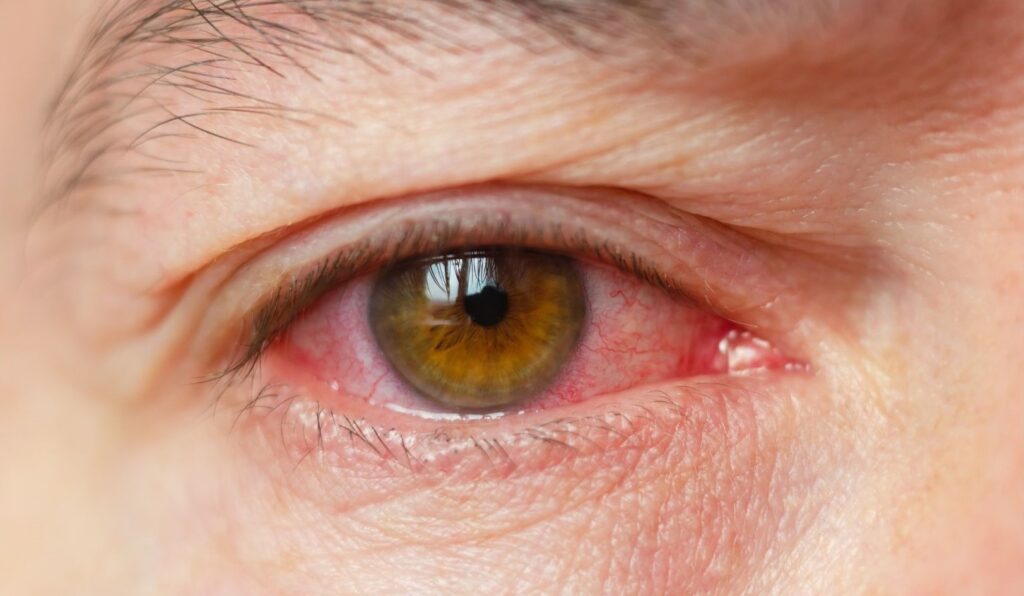 Risk of contact lenses