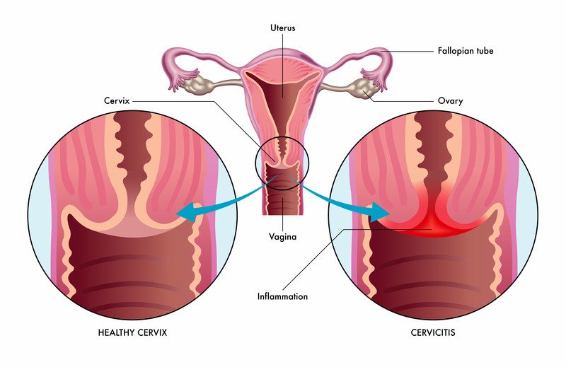 thermocoagulation for cervicitis nepal