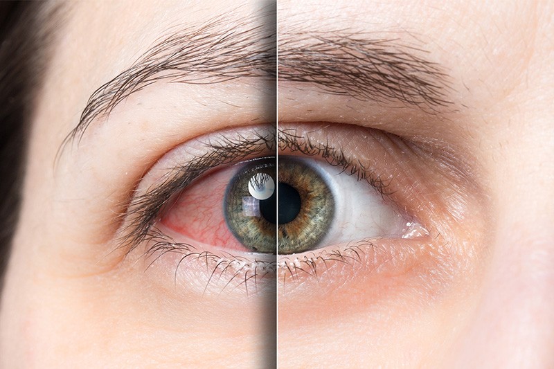Pink Eye (Conjunctivitis) / Eye Flu in Nepal