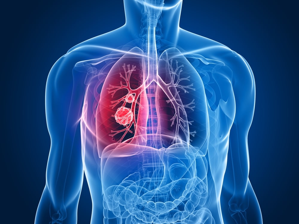 Lung Cancer: Things You Should Know About