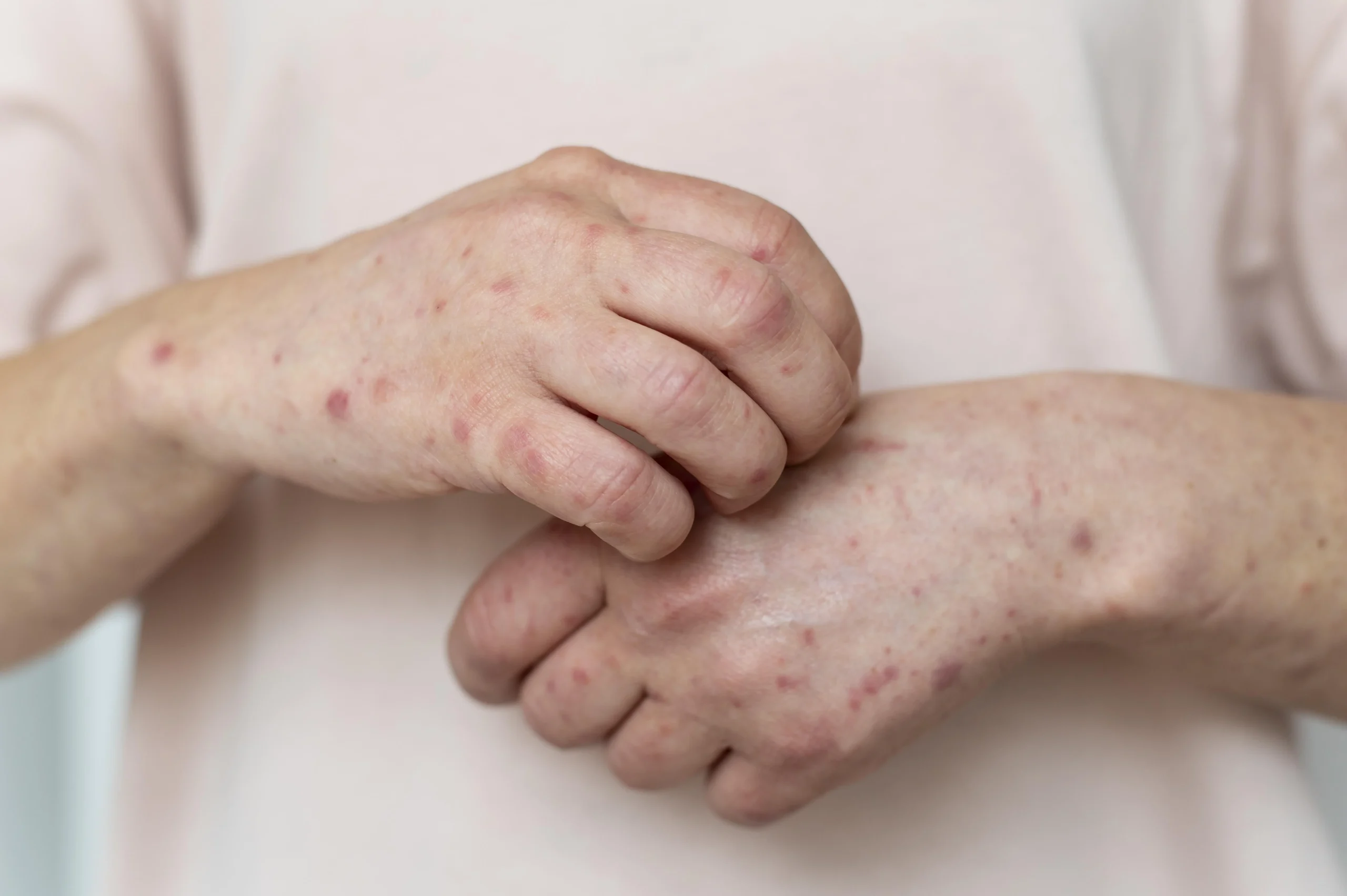 Everything You Need to Know About Mpox (Monkeypox) Virus and Its Transmission in Nepal