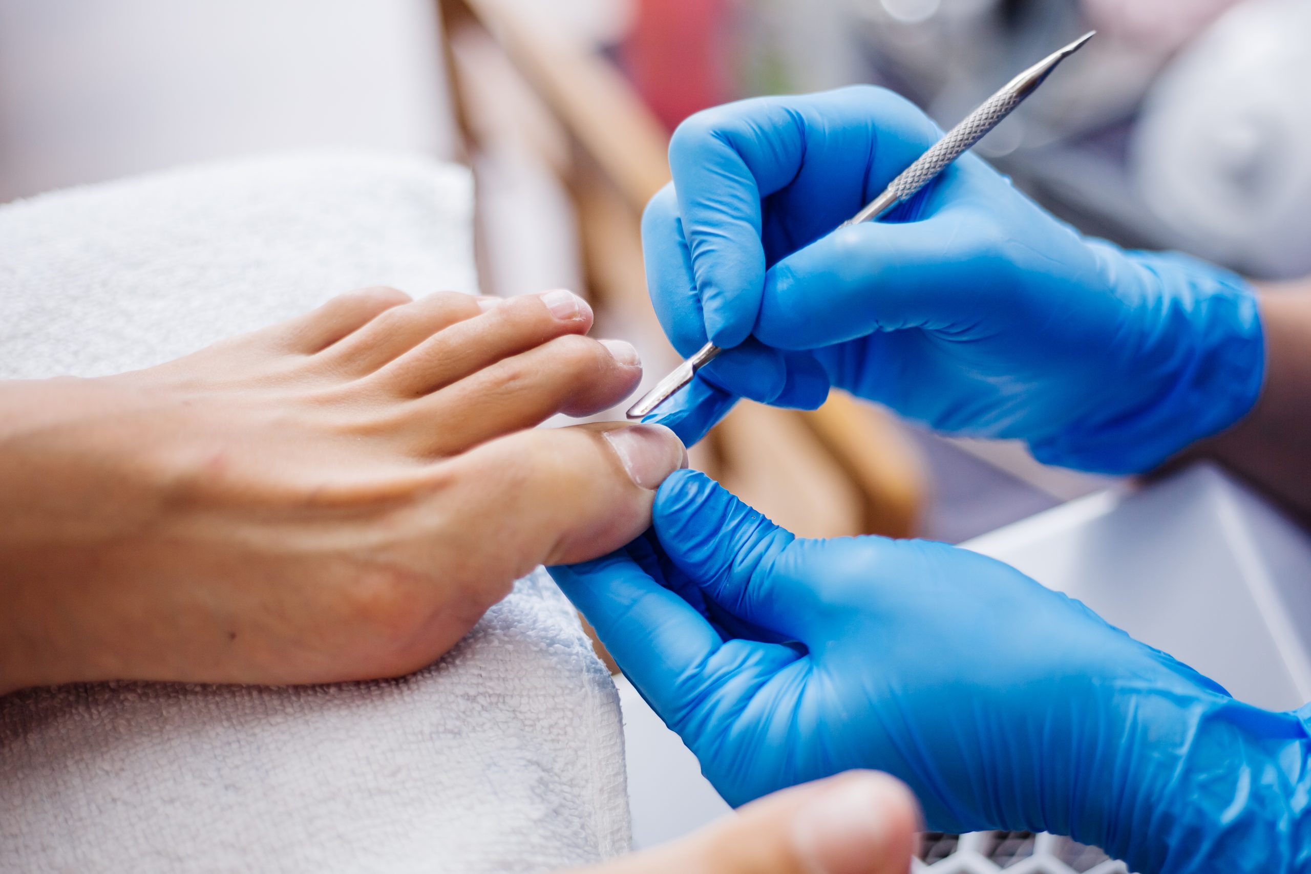 Ungiectomy with Matricectomy – Ingrown Toenail Removal