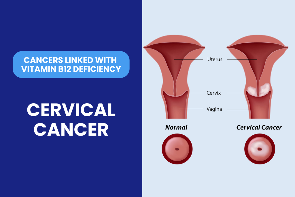 Vitamin B12 deficiency linked with cervical cancer