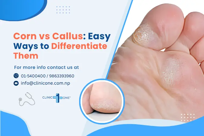 Corn vs Callus: Easy Ways to Differentiate Them