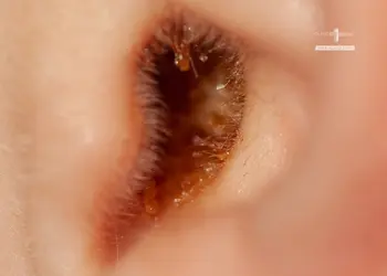 Waht is Ear Wax