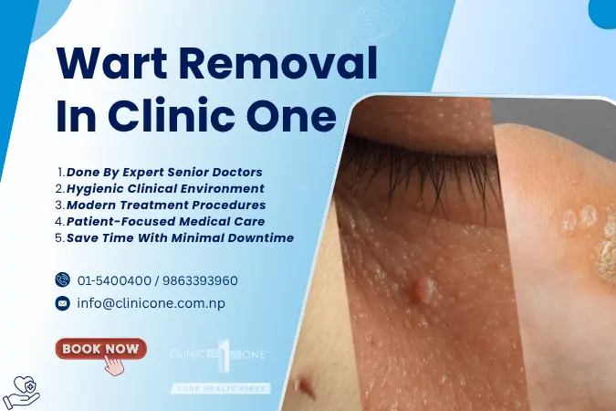 Wart Removal Treatment in Kathmandu, Nepal
