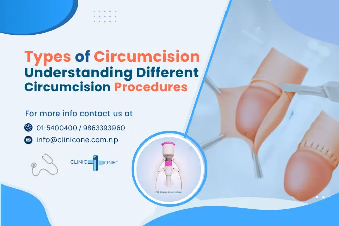 Types of Circumcision: Understanding Different Circumcision Procedures